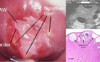 [Nhận biết viêm lộ tuyến nang naboth] – Nguyên nhân và biên chứng