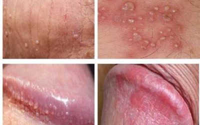 [Giải đáp] Viêm bao quy đầu có tự khỏi không? Cách điều trị như thế nào?