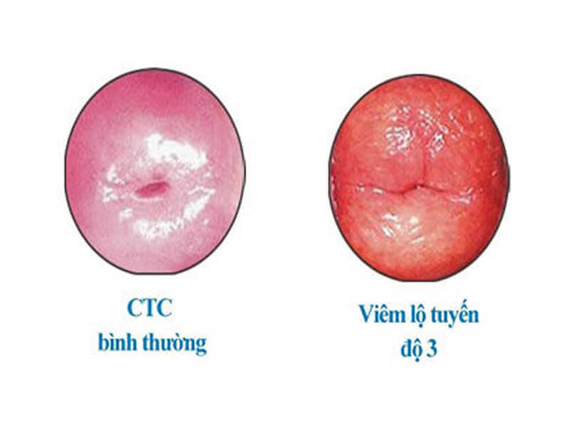 Các triệu chứng thường thấy khi mắc viêm lộ tuyến độ 3