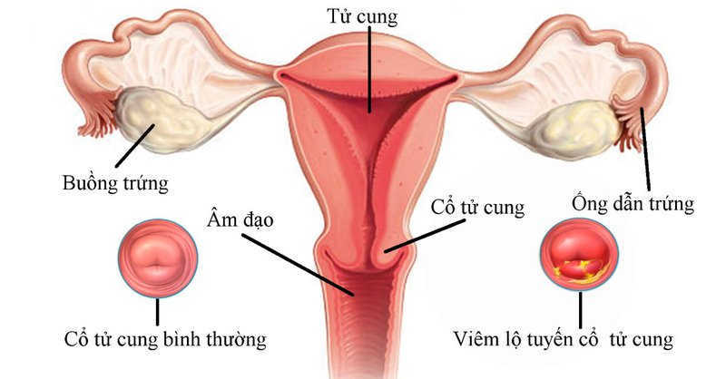 Viêm lộ tuyến độ 3 có ảnh hưởng đến sinh sản không?