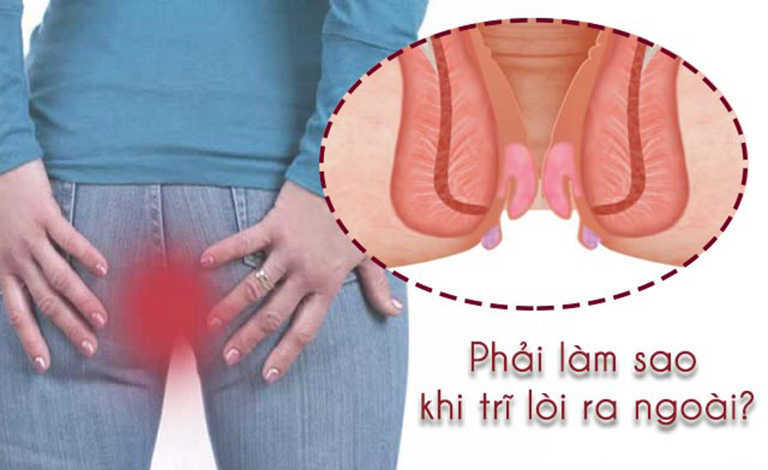 Phương pháp điều trị bệnh trĩ an toàn và triệt để