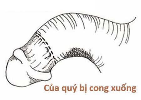 Tại sao dương vật lại bị cong xuống?