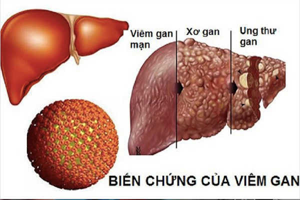 Người bệnh viêm gan B, men gan cao, mỡ máu