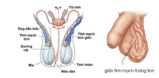 Mổ giãn tĩnh mạch thừng tinh bao nhiêu tiền? 