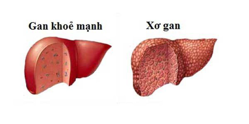 Xơ gan