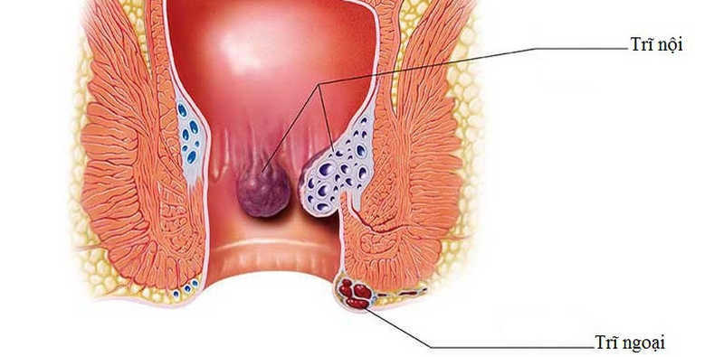 Bệnh trĩ là gì?