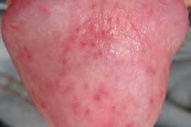 Đầu dương vật nổi mụn đỏ có nguy hiểm không?