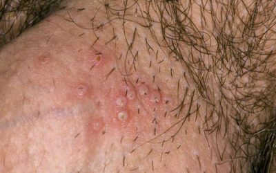 Mụn cóc ở cậu nhỏ: Dấu hiệu nhận biết và cách chữa trị