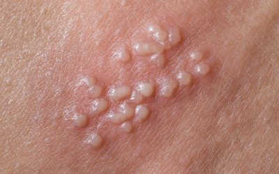 Mụn rộp sinh dục ở hậu môn: Nguyên nhân, dấu hiệu và cách chữa