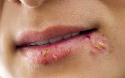 [Cảnh báo] Mụn rộp sinh dục ở miệng: Dấu hiệu & tác hại nguy hiểm