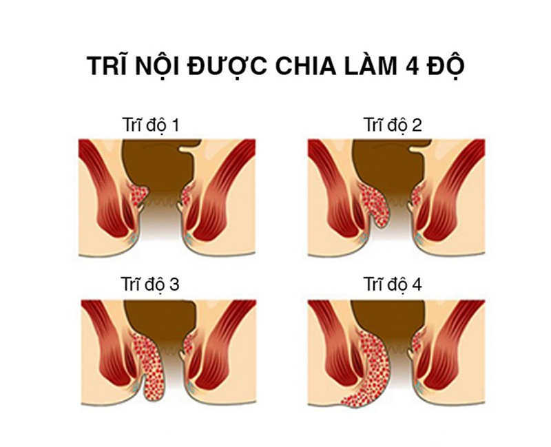 Trĩ nội