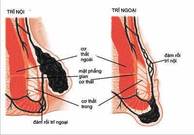 Cắt trĩ có khỏi hẳn không?