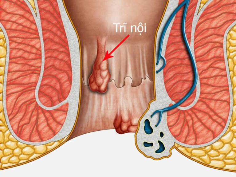 Cách phòng ngừa bệnh trĩ không tái phát