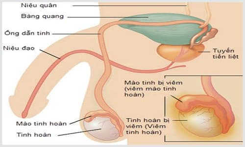 Phương pháp chữa bệnh viêm tinh hoàn cải tiến