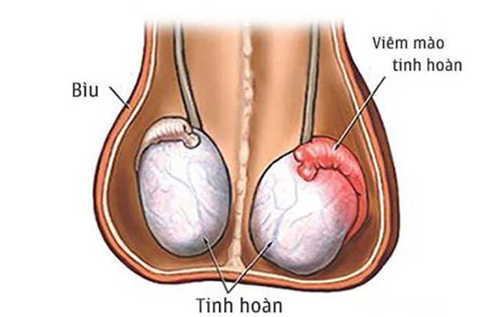 Viêm tinh hoàn là gì?