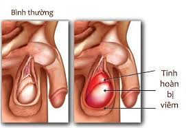 Bệnh viêm tinh hoàn nguyên nhân do đâu?