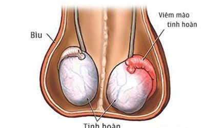 Chữa viêm tinh hoàn hết bao nhiêu tiền? [ Bảng giá cập nhật 2021 ]