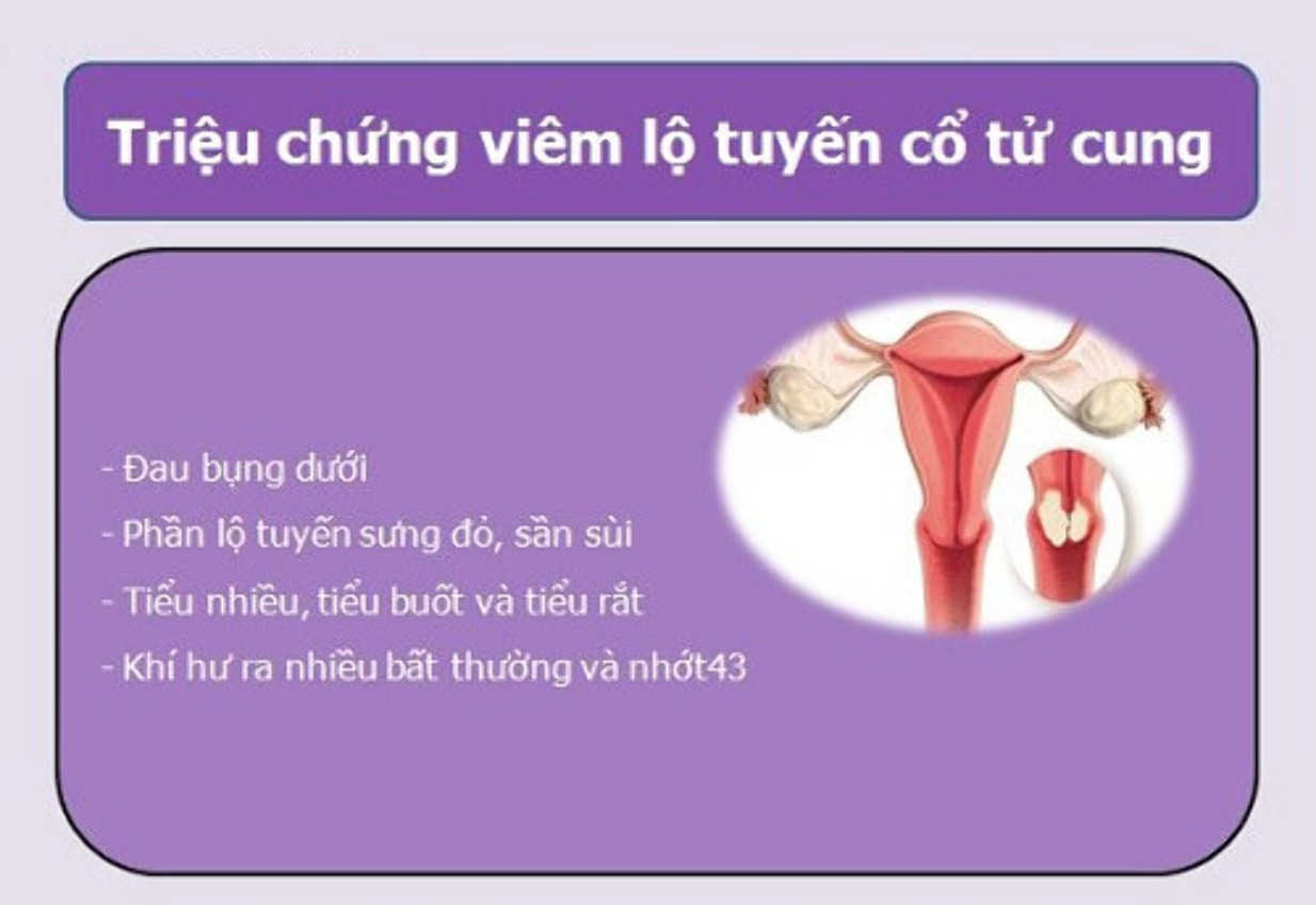 Dấu hiệu viêm lộ tuyến cổ tử cung được khám sớm?