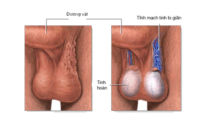 [Giải đáp] Viêm tinh hoàn uống kháng sinh gì để nhanh khỏi?