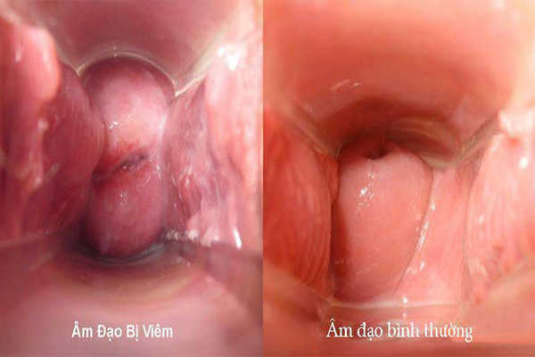 Do mắc bệnh viêm âm đạo ở nữ giới