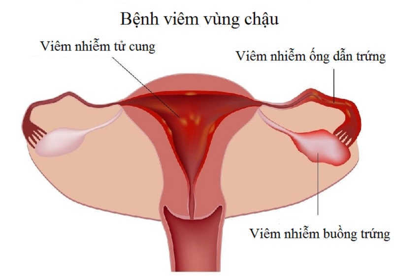 Do mắc bệnh viêm vùng chậu