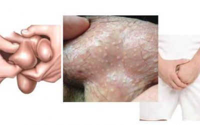 Dấu hiệu bệnh nấm bìu và cách điều trị tại nhà