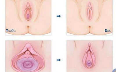 TOP 7 cách thu nhỏ vùng kín sau sinh hiệu quả nhất