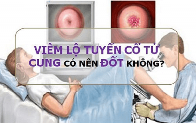 Viêm lộ tuyến có nên đốt điện không? Ảnh hưởng gì không?