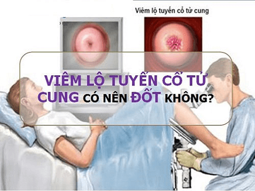 Có nên đốt viêm lộ tuyến cổ tử cung không?