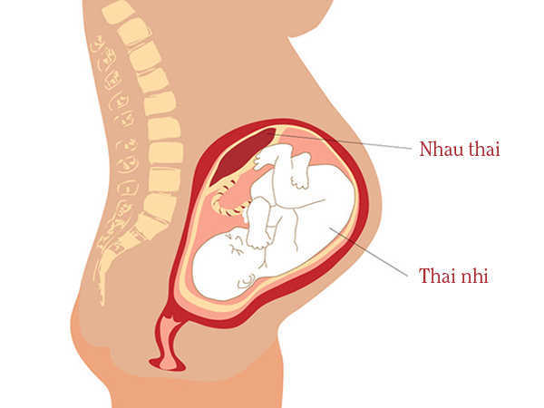 Do bất thường về nhau thai