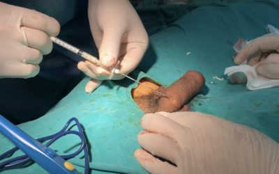 [Tìm hiểu] Tăng kích thước dương vật an toàn bằng filler