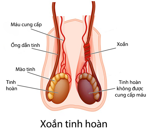 Xoắn thừng tinh hoàn