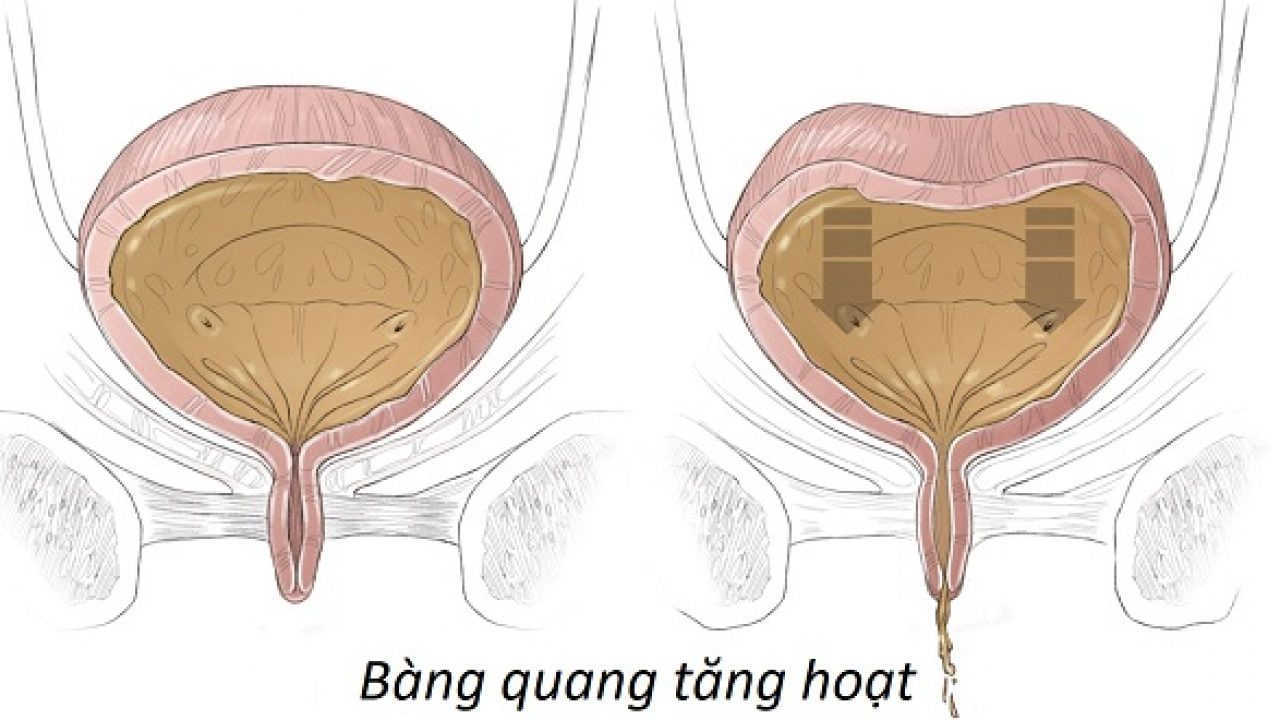 Bệnh bàng quang tăng hoạt