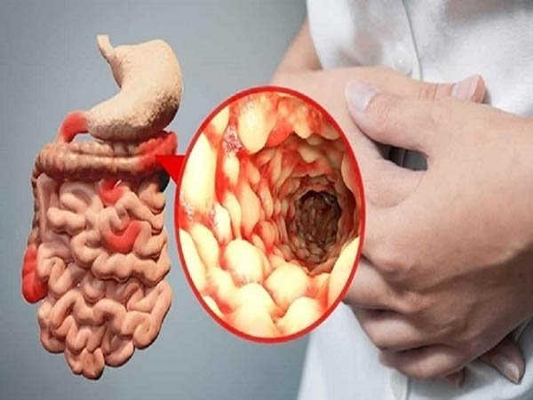 Bệnh Crohn