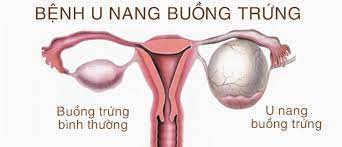 Bụng phình to bất thường do u nang buồng trứng