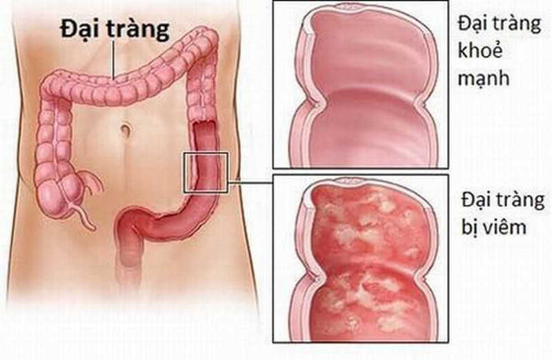 Do bị viêm đại tràng