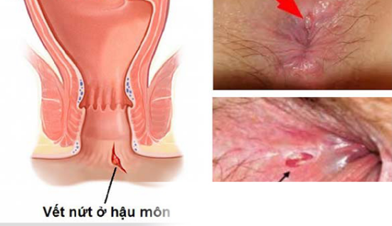 Nứt kẽ hậu môn