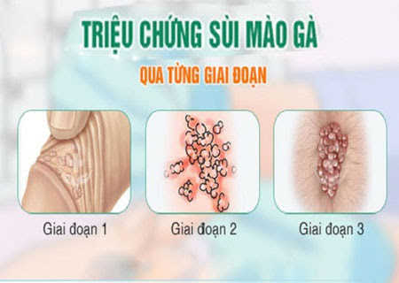 Sùi mào gà theo từng giai đoạn