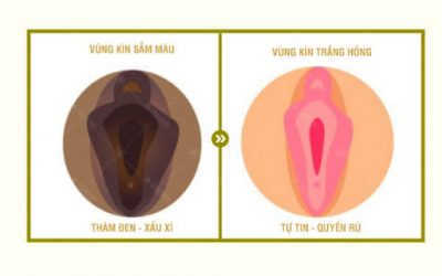 Vùng kín bị thâm đen phải làm sao – Nỗi lo của chị em phụ nữ