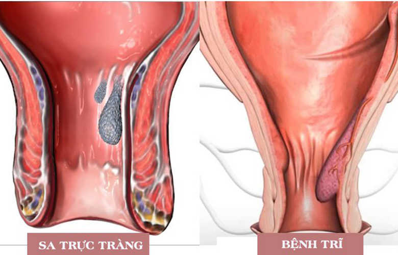 Tiềm ẩn nguy cơ mắc bệnh hậu môn – trực tràng