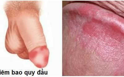 Quy đầu bị đau khi chạm vào là bệnh gì? Cách điều trị hiệu quả