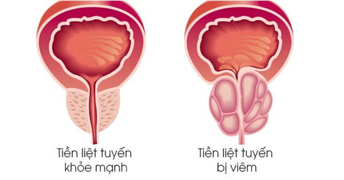 Bệnh viêm tuyến tiền liệt