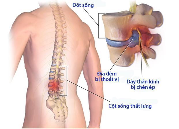 Thoát vị đĩa đệm là bệnh gì?