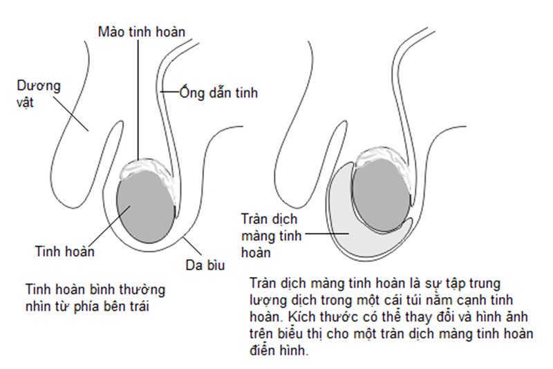 Tràn dịch tinh hoàn ở trẻ sơ sinh là gì