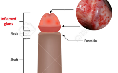 Do balanitis