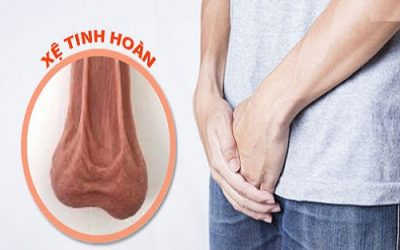 Xệ tinh hoàn có sao không? Có chữa được không?
