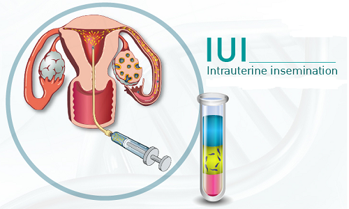 Địa chỉ uy tín chuyên điều trị vô sinh hiếm muộn bằng IUI