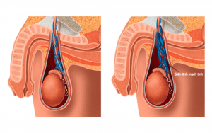 Giãn tĩnh mạch thừng tinh