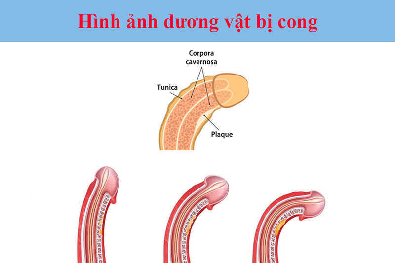 Nguyên nhân khiến dương vật cong sang trái