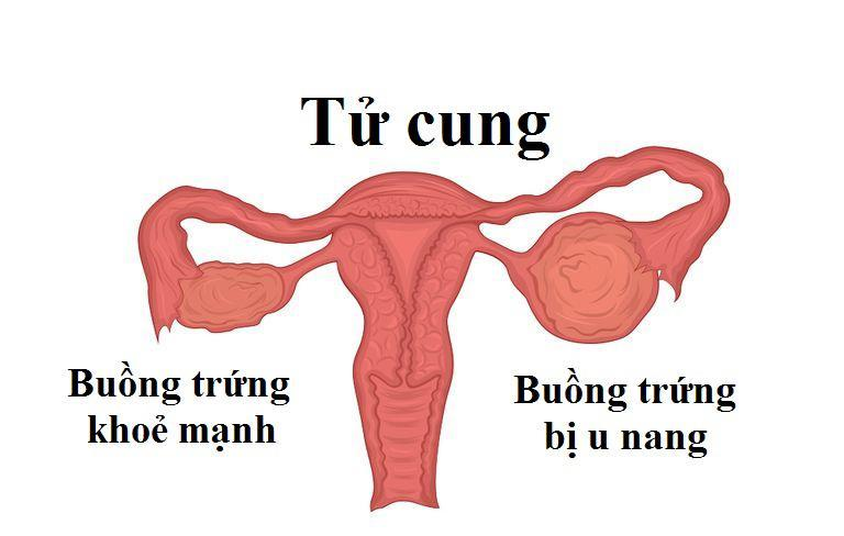 U nang buồng trứng